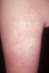 Picture of Keratosis Pilaris (aka: KP, chicken skin) bumps on the back of the arm