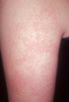 What is Keratosis Pilaris?