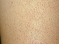 Keratosis Pilaris