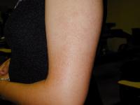 Keratosis Pilaris