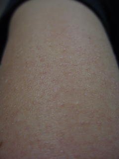 Keratosis Pilaris