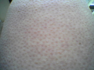 Keratosis Pilaris